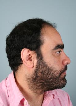 Before Hair Transplant&nbsp;2 Sessions (Areas)